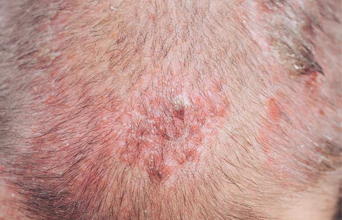 Scalp Problems Causes Symptoms Types And How To Take Care Wpc Trends 