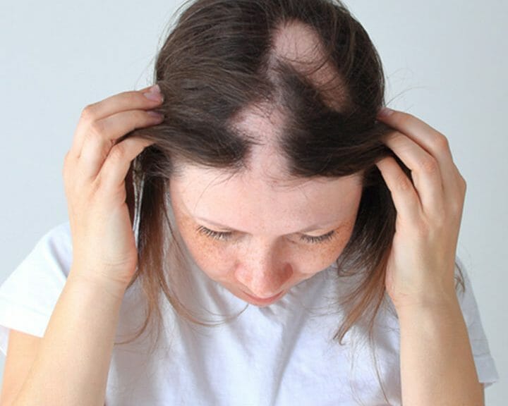 Alopecia Areata Hair Loss – Causes, Symptoms, & Treatments - WPC Trends