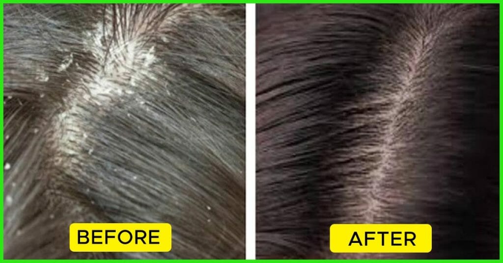 Different Types Of Dandruff And How To Stop Them - WPC Trends