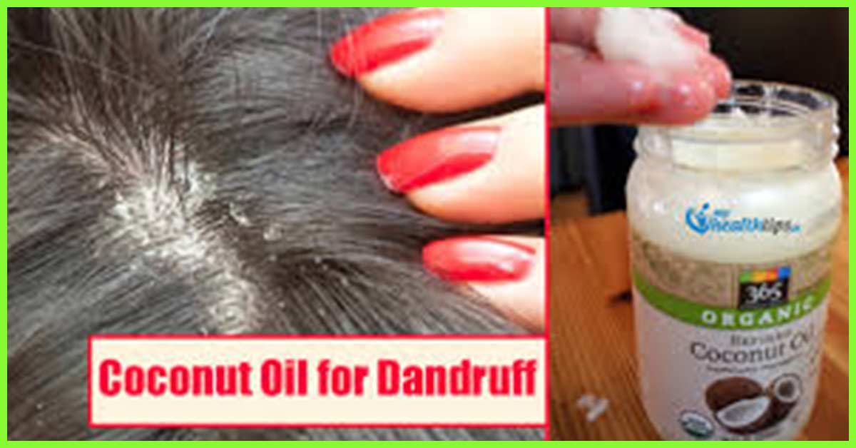 How To Use Coconut Oil For Dandruff Wpc Trends 8640